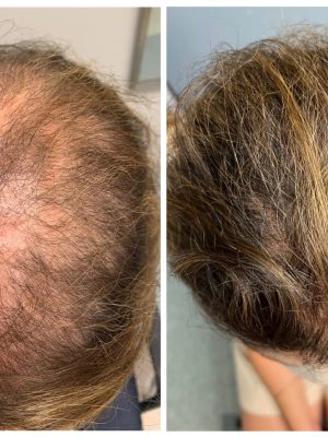 Hairloss program